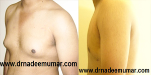 breast-reduction-before-after