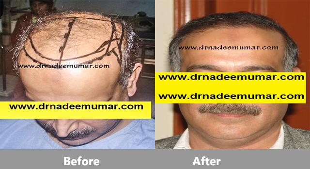 fue-hair-transpalnt-before-after