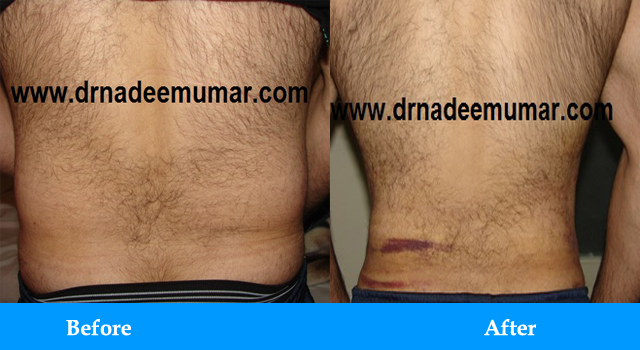 liposuction-before-after