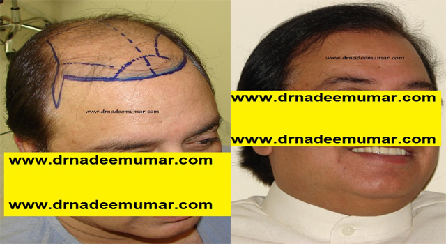 FUE Hair Transplant in Islamabad & Rawalpindi | FUE Hair Restoration |  Procedure, Before After